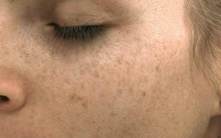 Cilt Lekeleri Neden Olur ve Tedavisi nedir?