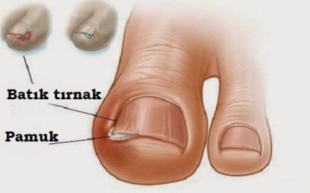 Tırnak Batması Nedir, Kimlerde Görülür Tedavisi nedir?