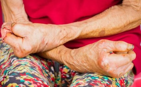 Dünya Cüzzam (Lepra) Günü